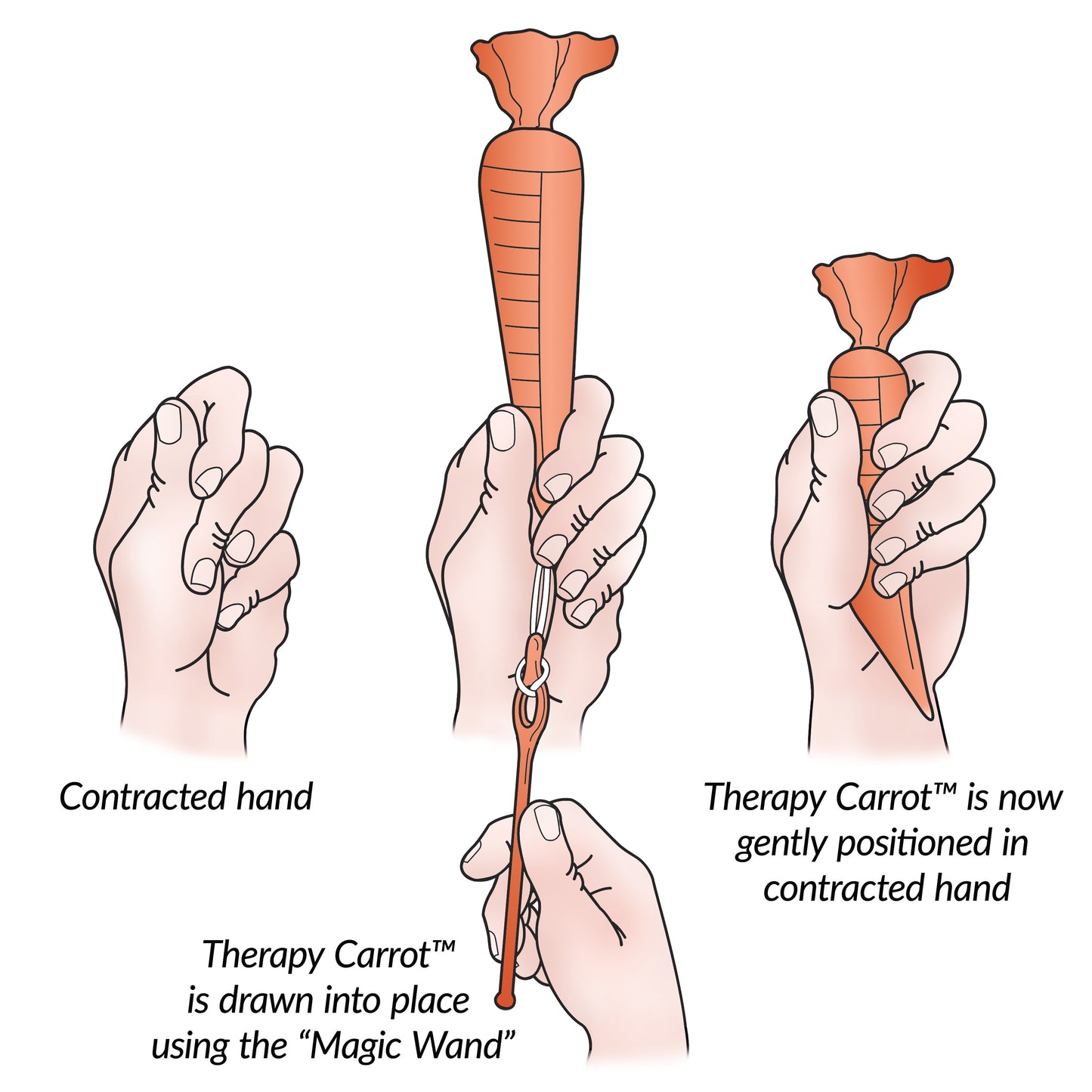 Hands with a contracted grip using the AliMed Original Therapy Carrot Hand Contracture Orthosis Kit. A diagram explains how .