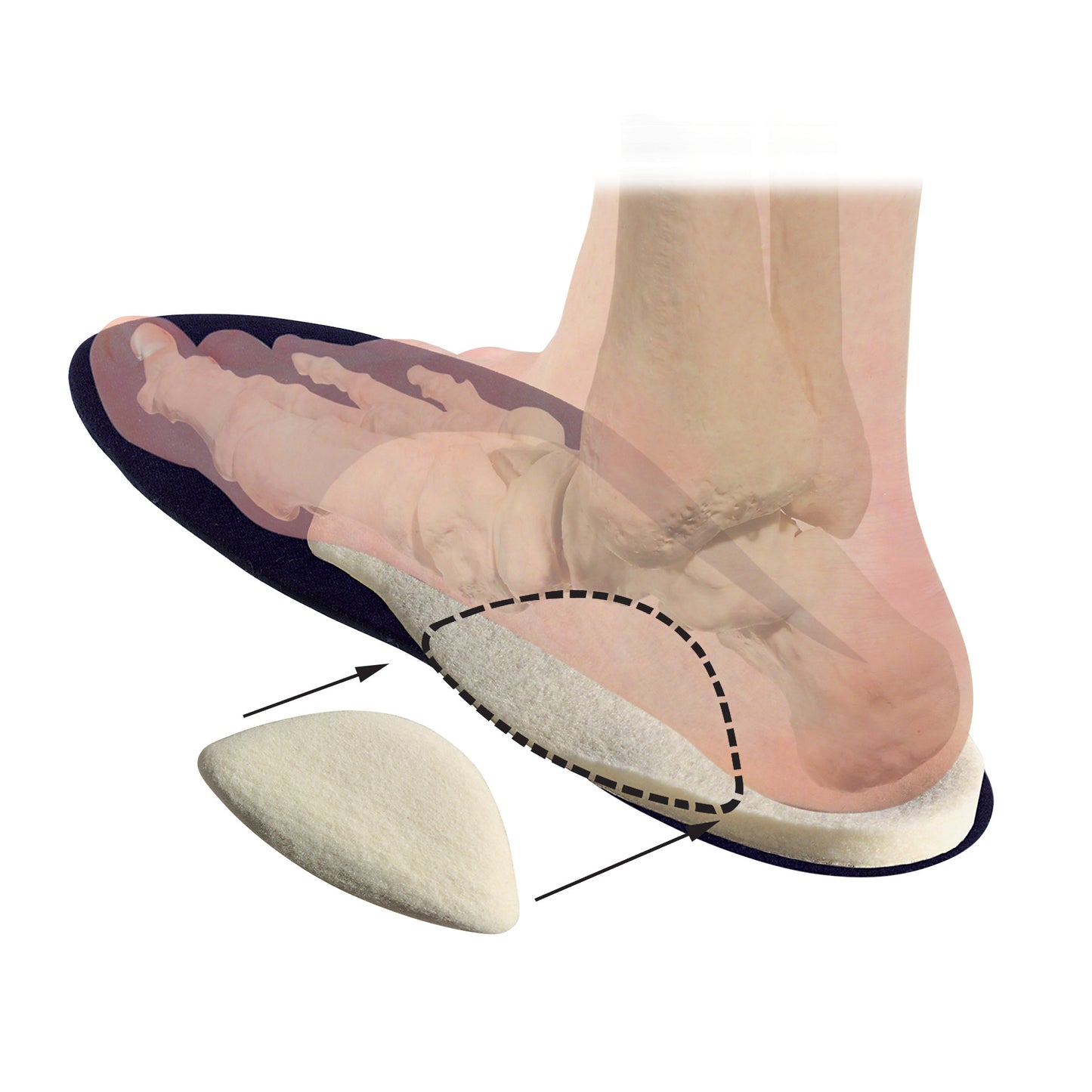Illustration of a foot with a semi-transparent overlay showing a Hapad Scaphoid Pad placed under the arch for support.