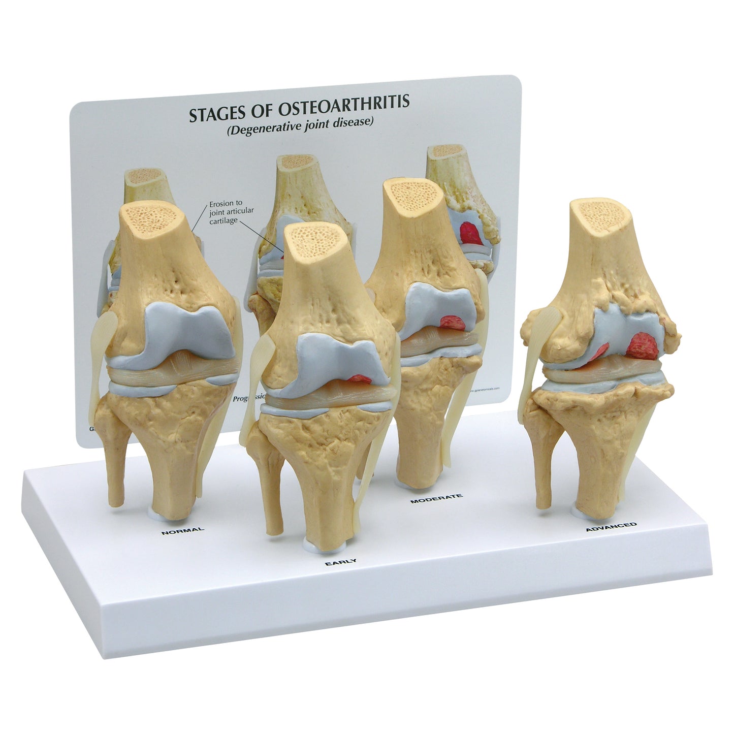 GPI Anatomicals 4-Stage Osteoarthritis Knee Model displays normal, early, moderate, and advanced stages of the disease in knee joints.