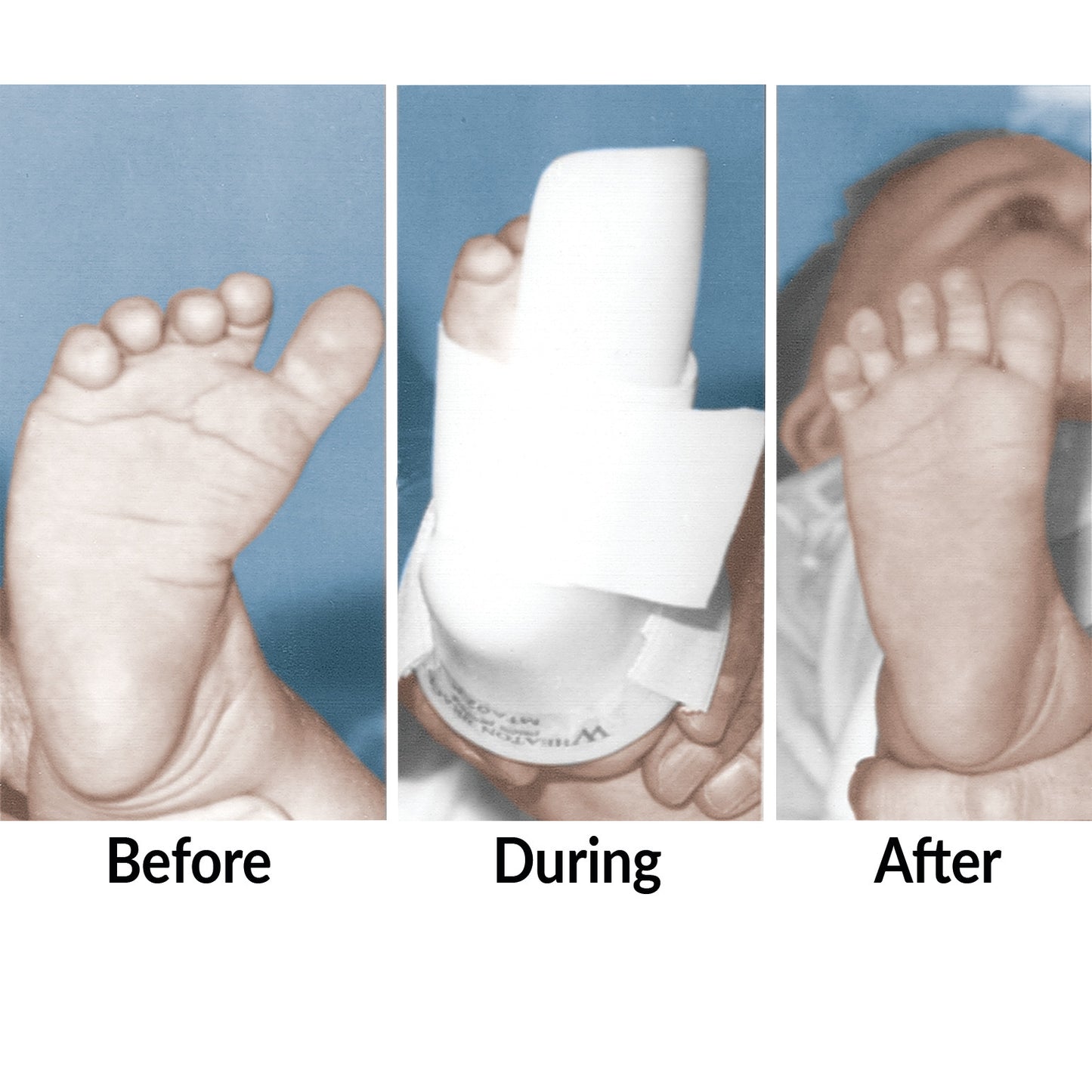Three side-by-side images show a baby's foot: uncorrected, wearing the Wheaton Brace AFO TEV-CRB Series, and corrected.