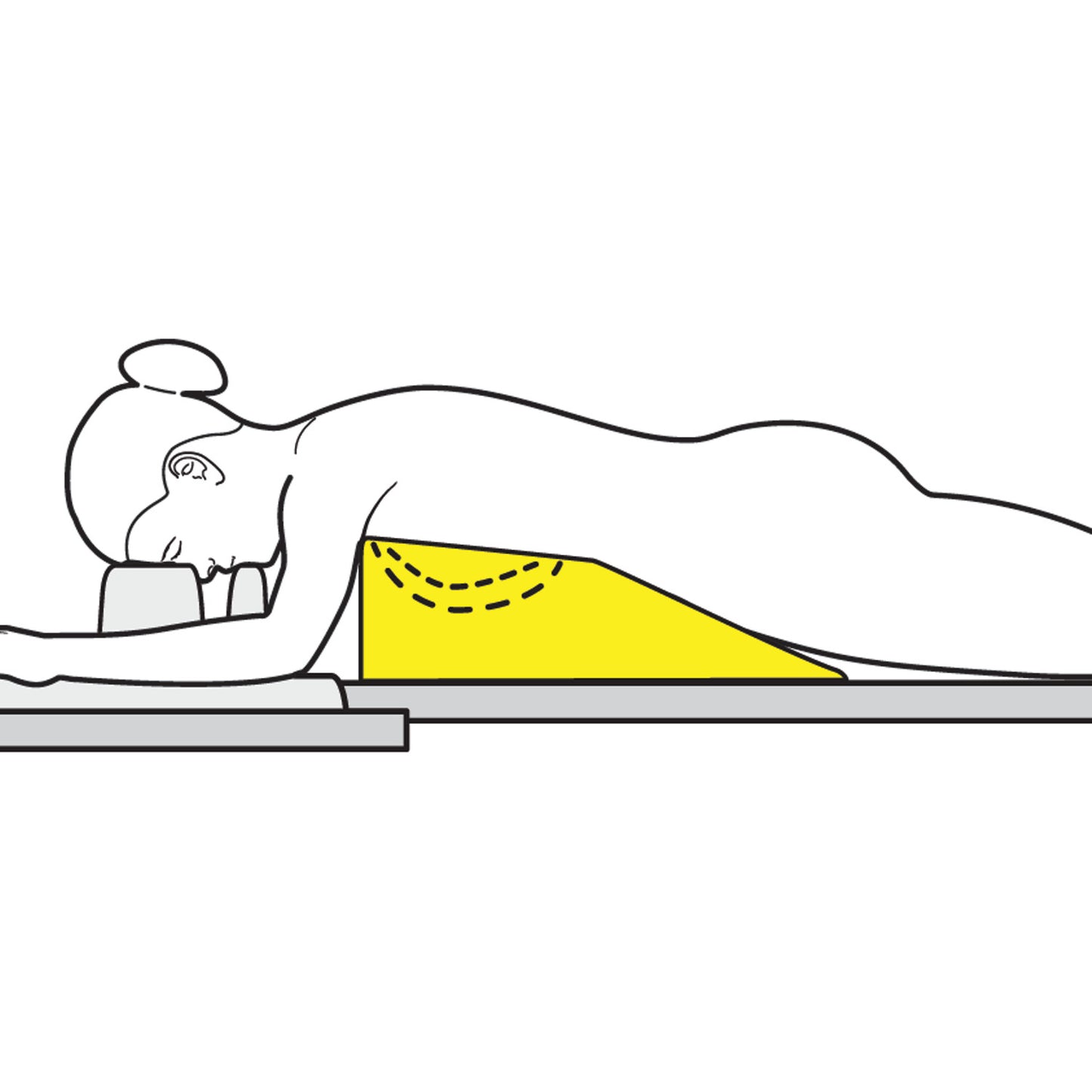 A woman lies prone on a bed using the AliMed Protecta-Coat Female Prone Positioner, a yellow wedge cushion supporting her torso.