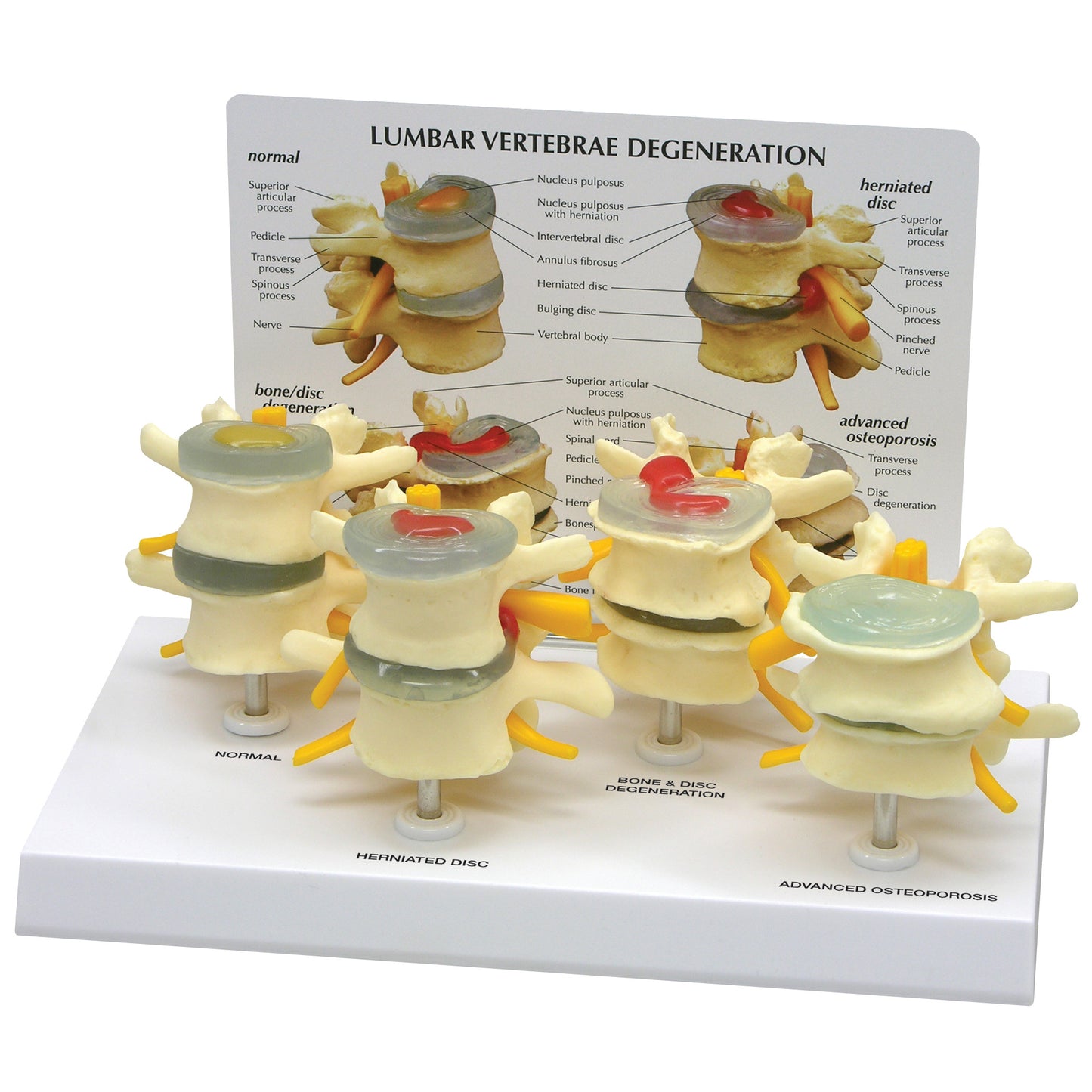 The GPI Anatomicals 4-Stage Vertebrae Model displays stages of lumbar degeneration, from normal to advanced osteoporosis.