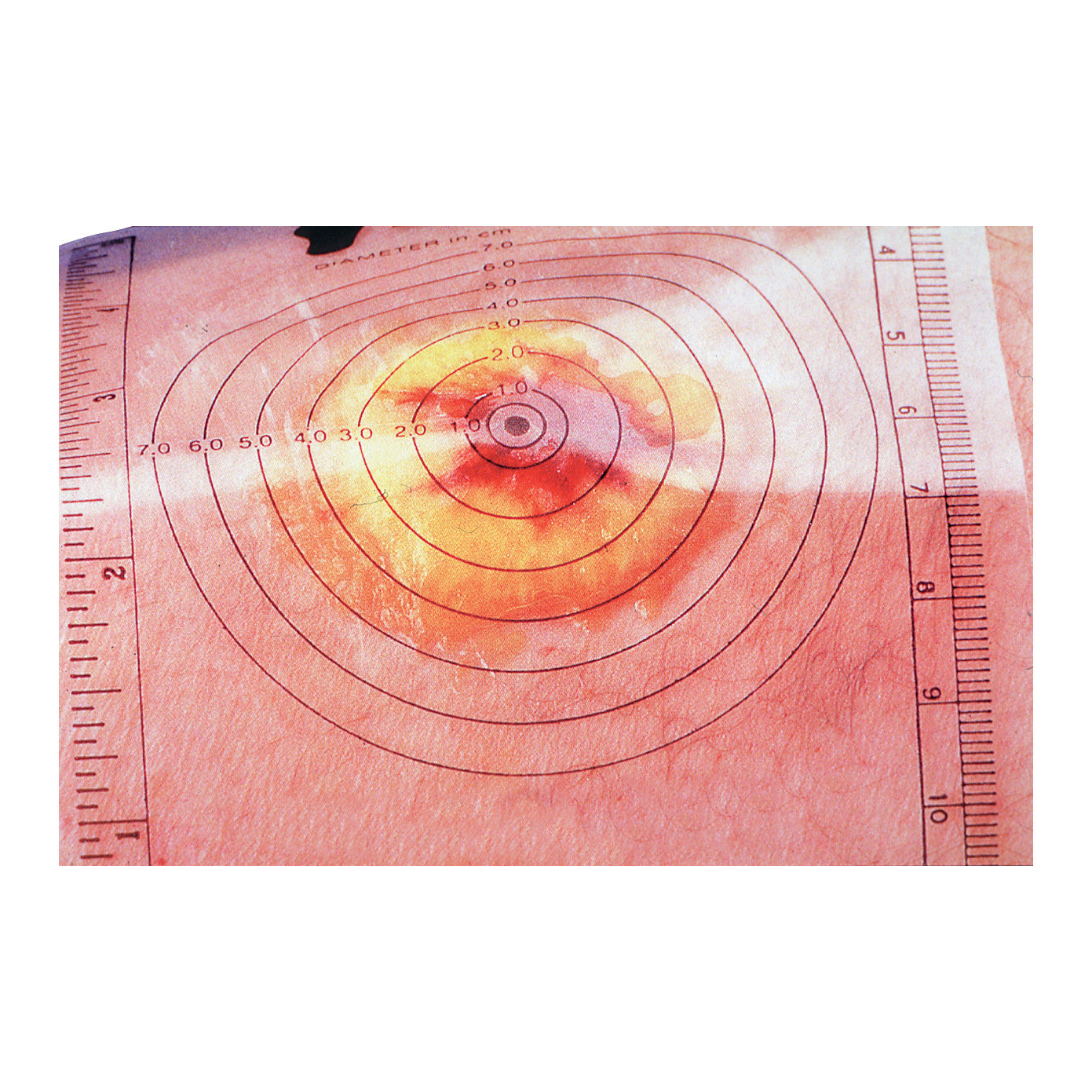 The Disposable Wound Measuring Guide is placed on skin showing a circular wound, with measurement scales on two sides.