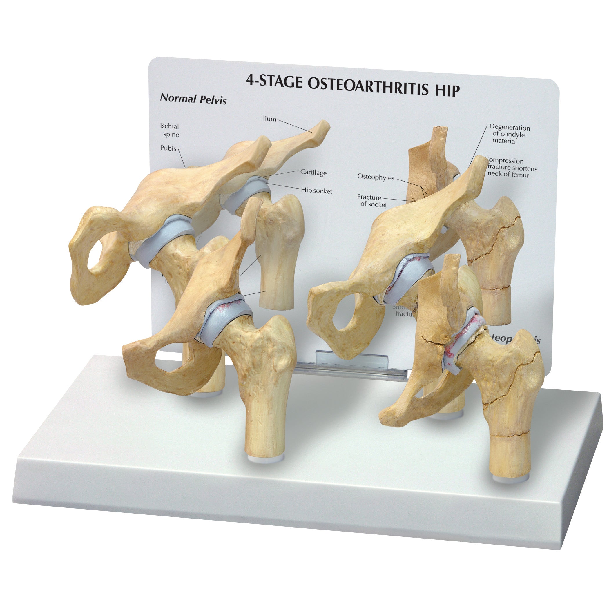 The GPI Anatomicals 4-Stage Arthritic Hip Model displays four bone models illustrating the progression of hip osteoarthritis.
