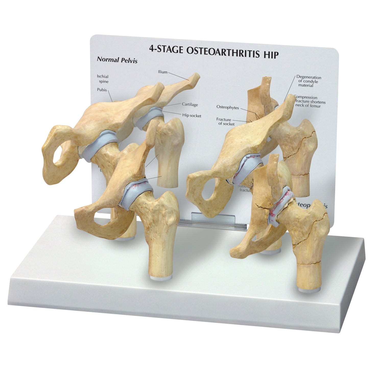 The GPI Anatomicals 4-Stage Arthritic Hip Model displays four bone models illustrating the progression of hip osteoarthritis.