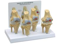 GPI Anatomicals® 4 Stage Osteoarthritis Knee Model