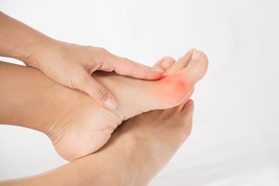 Bunions: Symptoms and Treatment