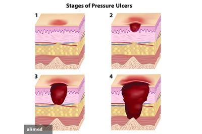 stages of pressure ulcers
