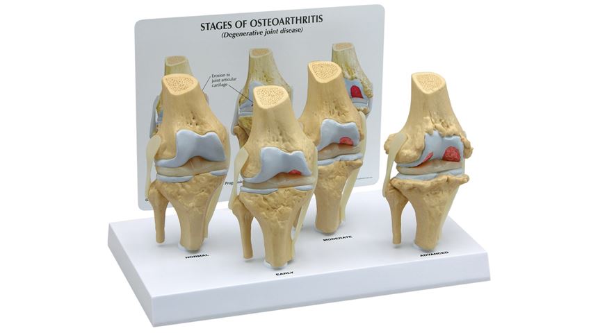 GPI Anatomicals® 4 Stage Osteoarthritis Knee Model