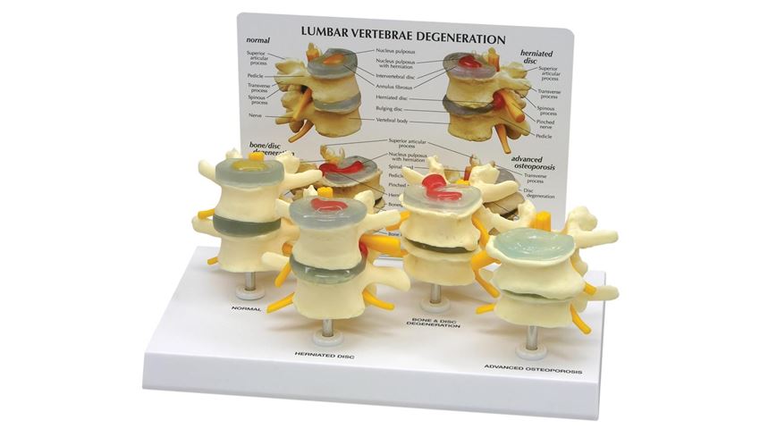 GPI Anatomicals® 4 Stage Vertebrae Model