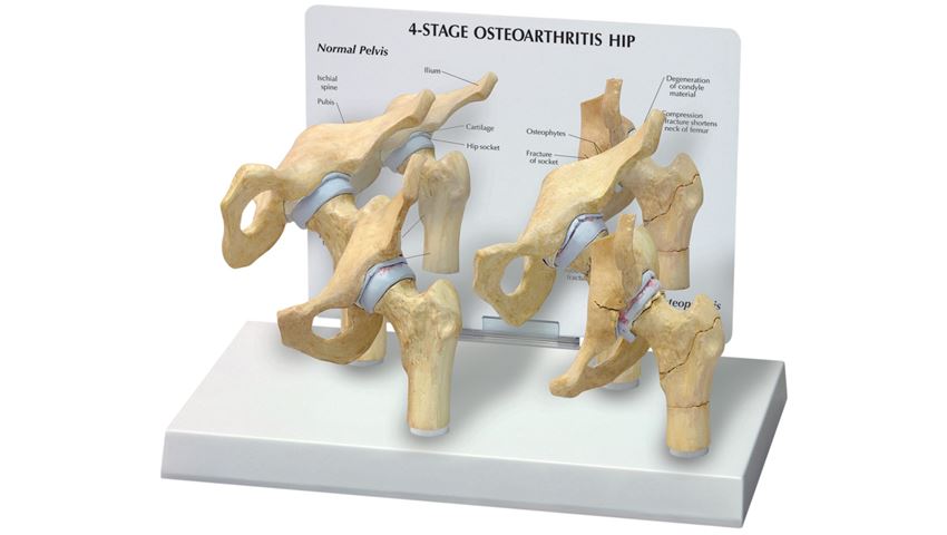 GPI Anatomicals® 4-Stage Arthritic Hip Model