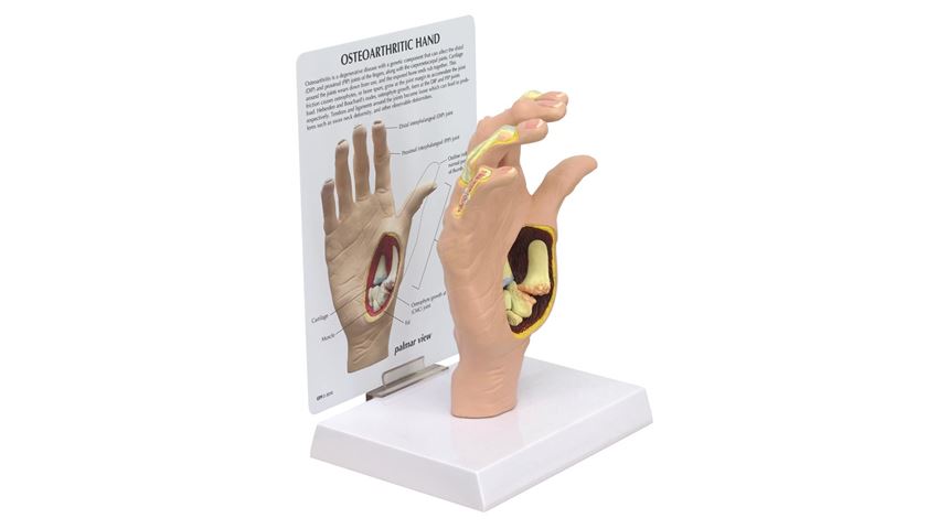 GPI Anatomicals® Osteoarthritis (OA) Hand Model