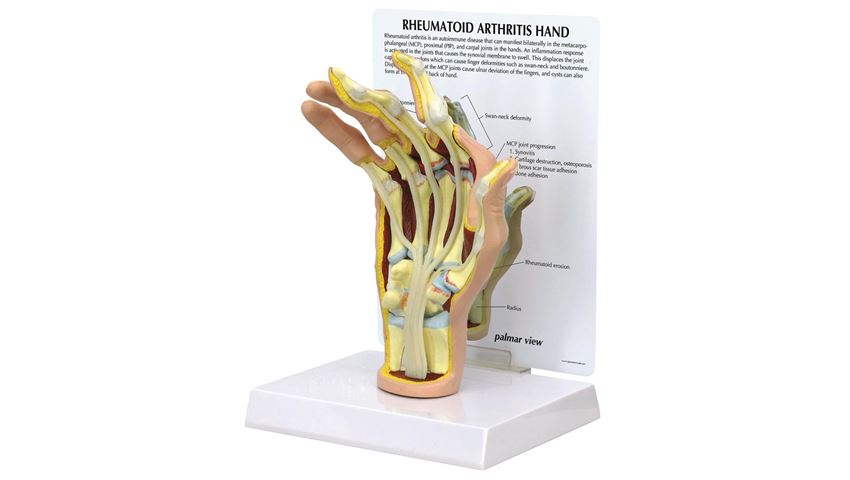 GPI Anatomicals® Rheumatoid Arthritis (RA) Hand Model