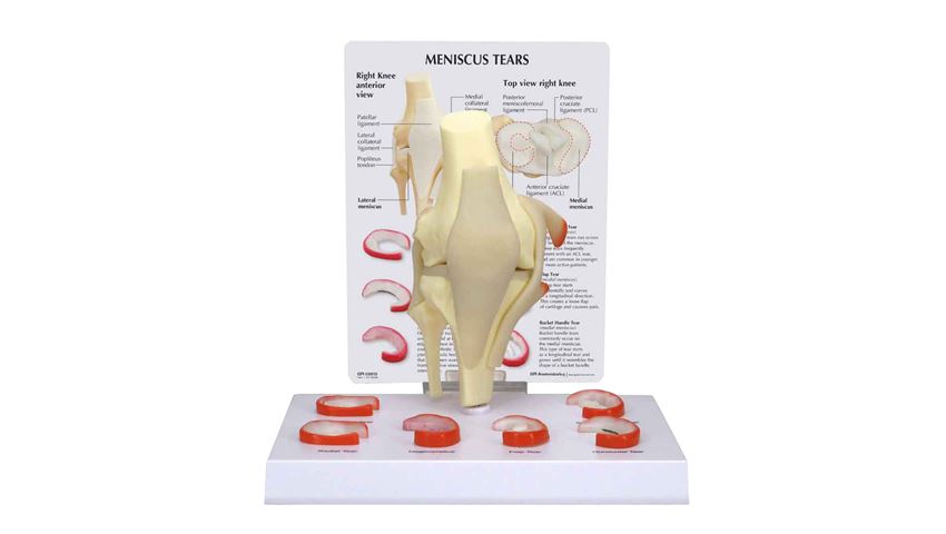 GPI Anatomicals® Meniscus 6 Tears Model
