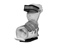 Adjustable Telescoping Foot Splint