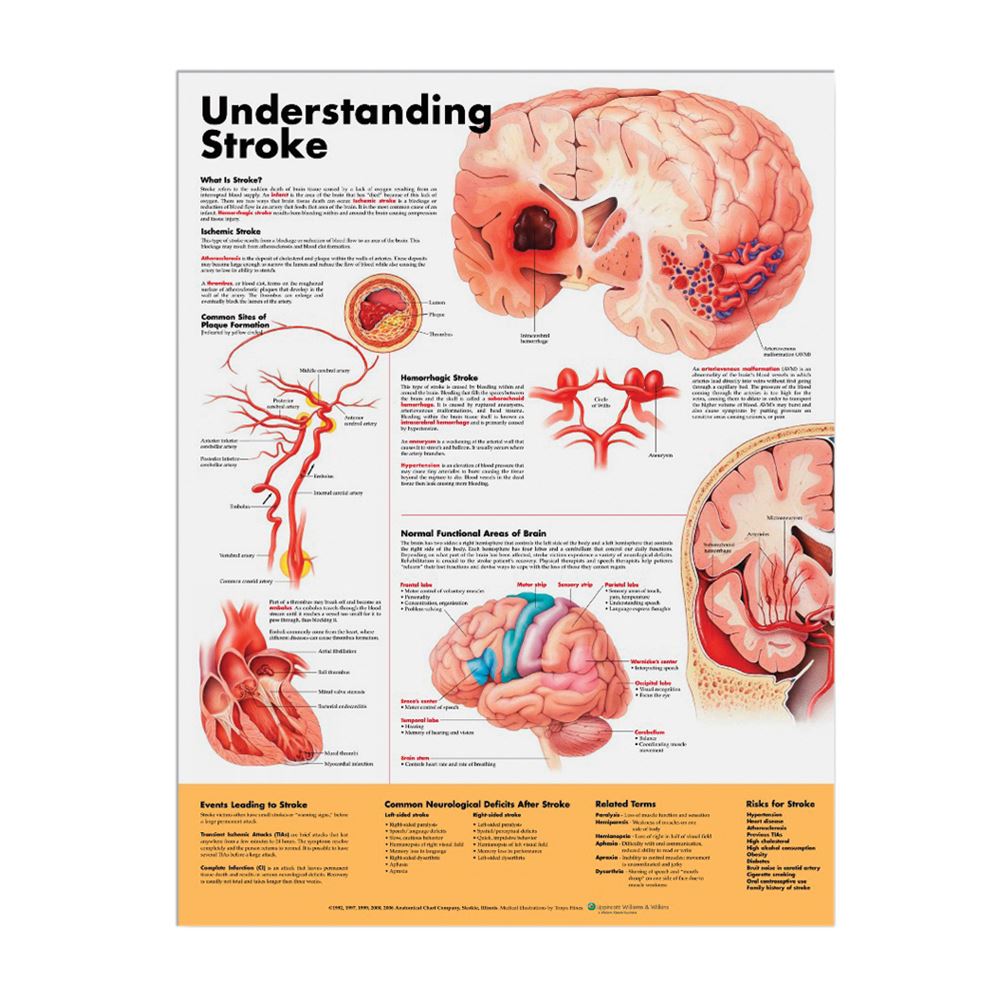 Anatomical Chart: Understanding Stroke