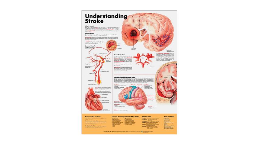 Anatomical Chart: Understanding Stroke