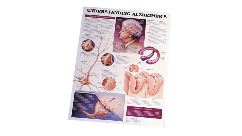 Understanding Alzheimer's Chart