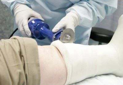 doctor cutting off cast with cast saw