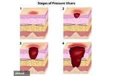 Medicare Data May Underestimate Pressure Ulcer Problem