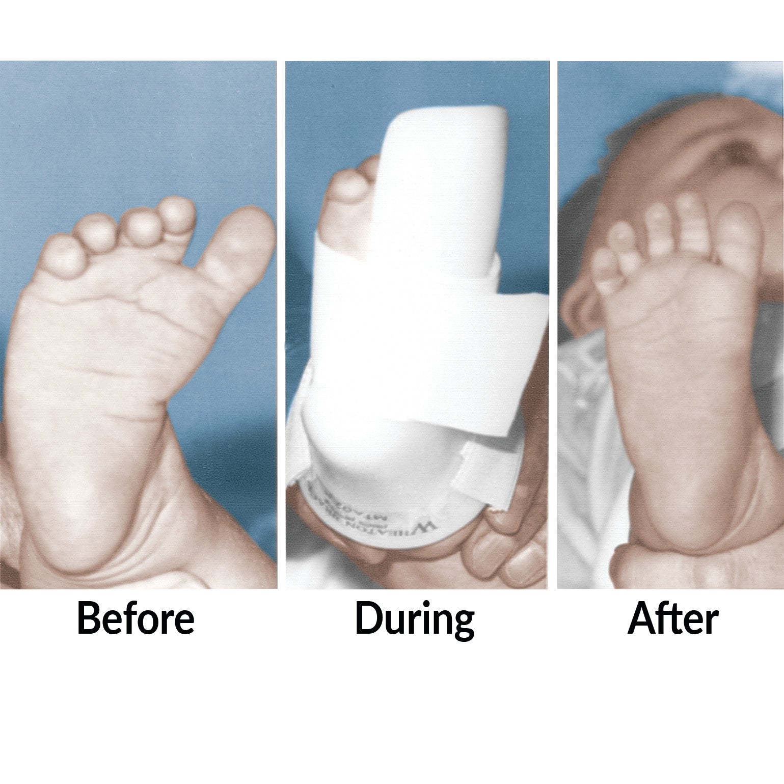 Three side-by-side images show a baby's foot: uncorrected, wearing the Wheaton Brace AFO TEV-CRB Series, and corrected.