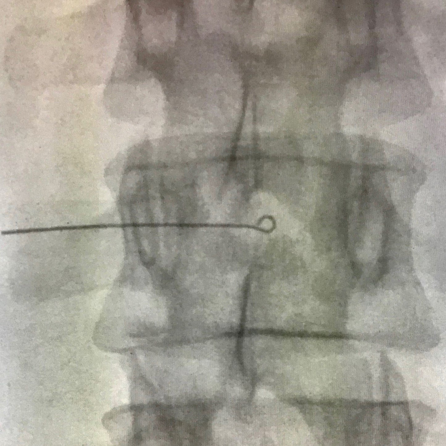 X-ray image showing a Viscot Accumark Radiopaque Injection Site Marker, visible as a thin line with a loop, used for marking.