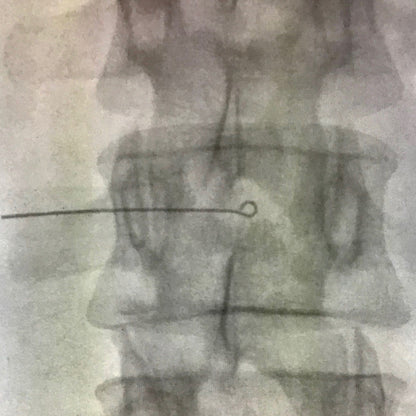 X-ray image showing a Viscot Accumark Radiopaque Injection Site Marker, visible as a thin line with a loop, used for marking.