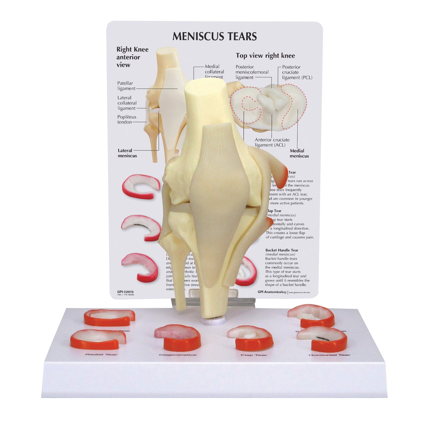 The GPI Anatomicals Meniscus 6 Tears Model depicts a knee joint with labeled ligament parts and six types of meniscus tears.