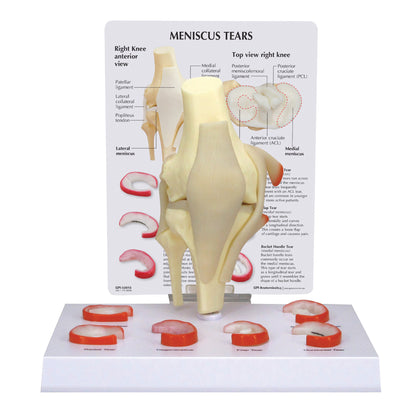 The GPI Anatomicals Meniscus 6 Tears Model depicts a knee joint with labeled ligament parts and six types of meniscus tears.