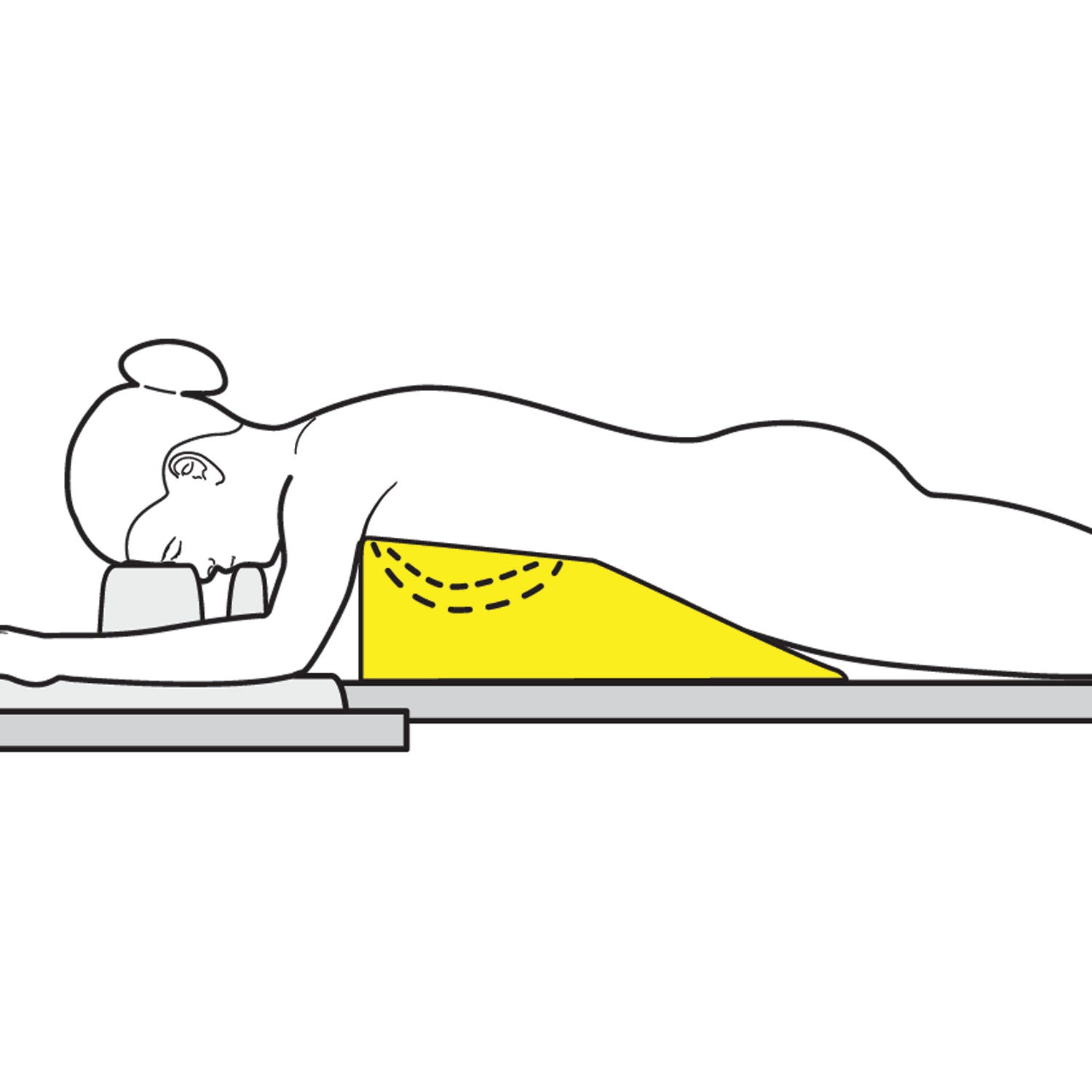 A woman lies prone on a bed using the AliMed Protecta-Coat Female Prone Positioner, a yellow wedge cushion supporting her torso.