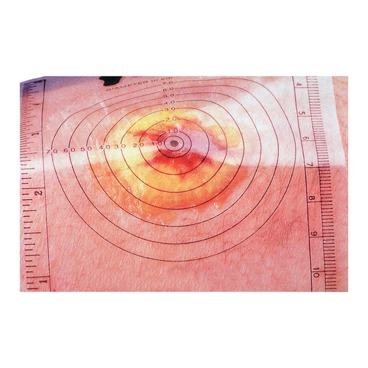 The Disposable Wound Measuring Guide is placed on skin showing a circular wound, with measurement scales on two sides.