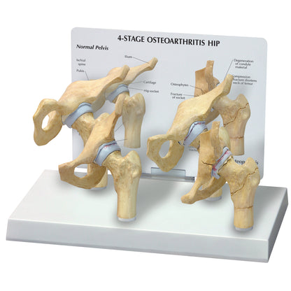 The GPI Anatomicals 4-Stage Arthritic Hip Model displays four bone models illustrating the progression of hip osteoarthritis.