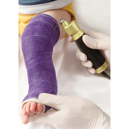 A gloved hand uses the DeSoutter CleanCast CSP-201 Pediatric Cast Saw System to cut a purple cast on a child's leg.