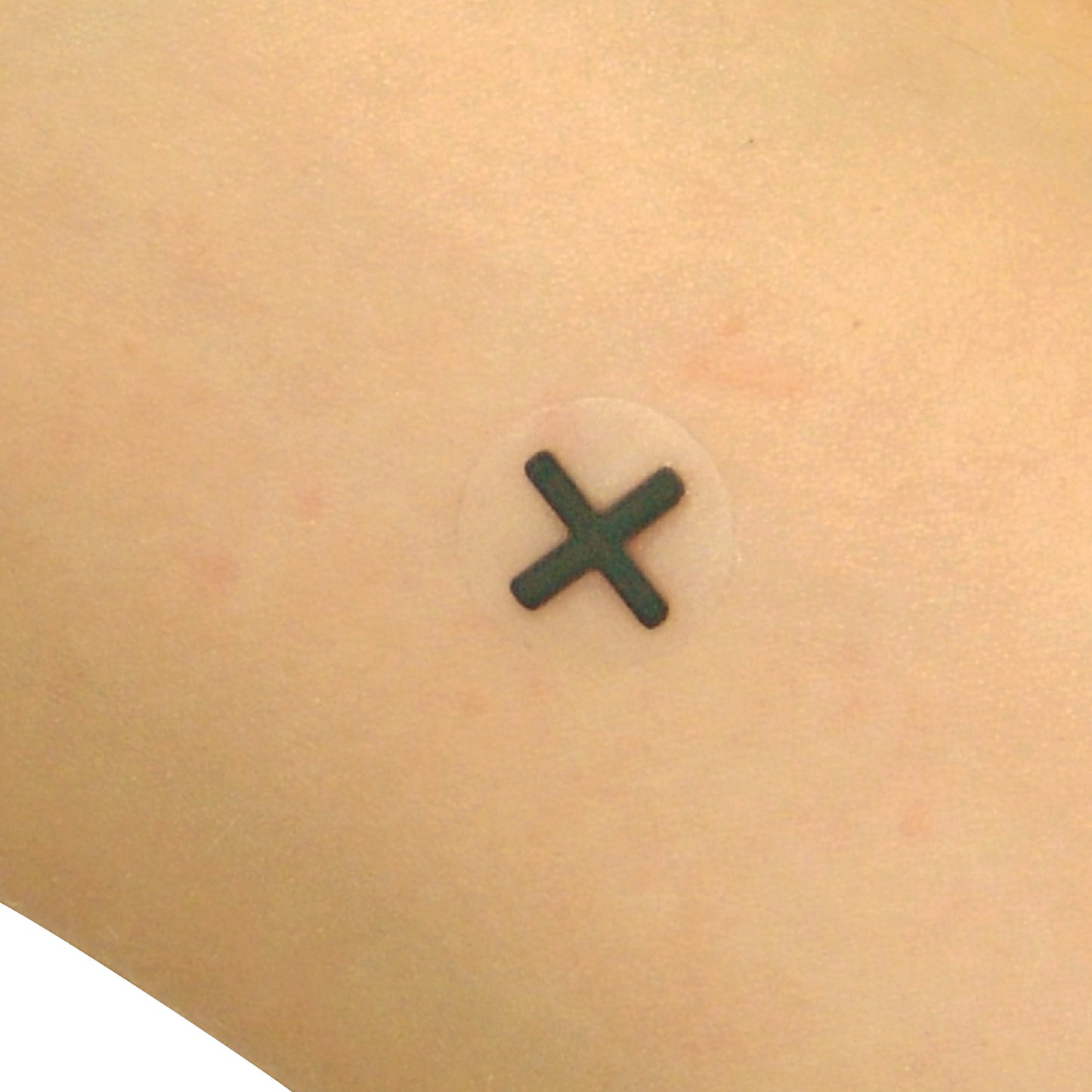 A small Indicator Radiopaque Marker in the shape of an "X" is placed on skin, surrounded by a transparent circular adhesive.