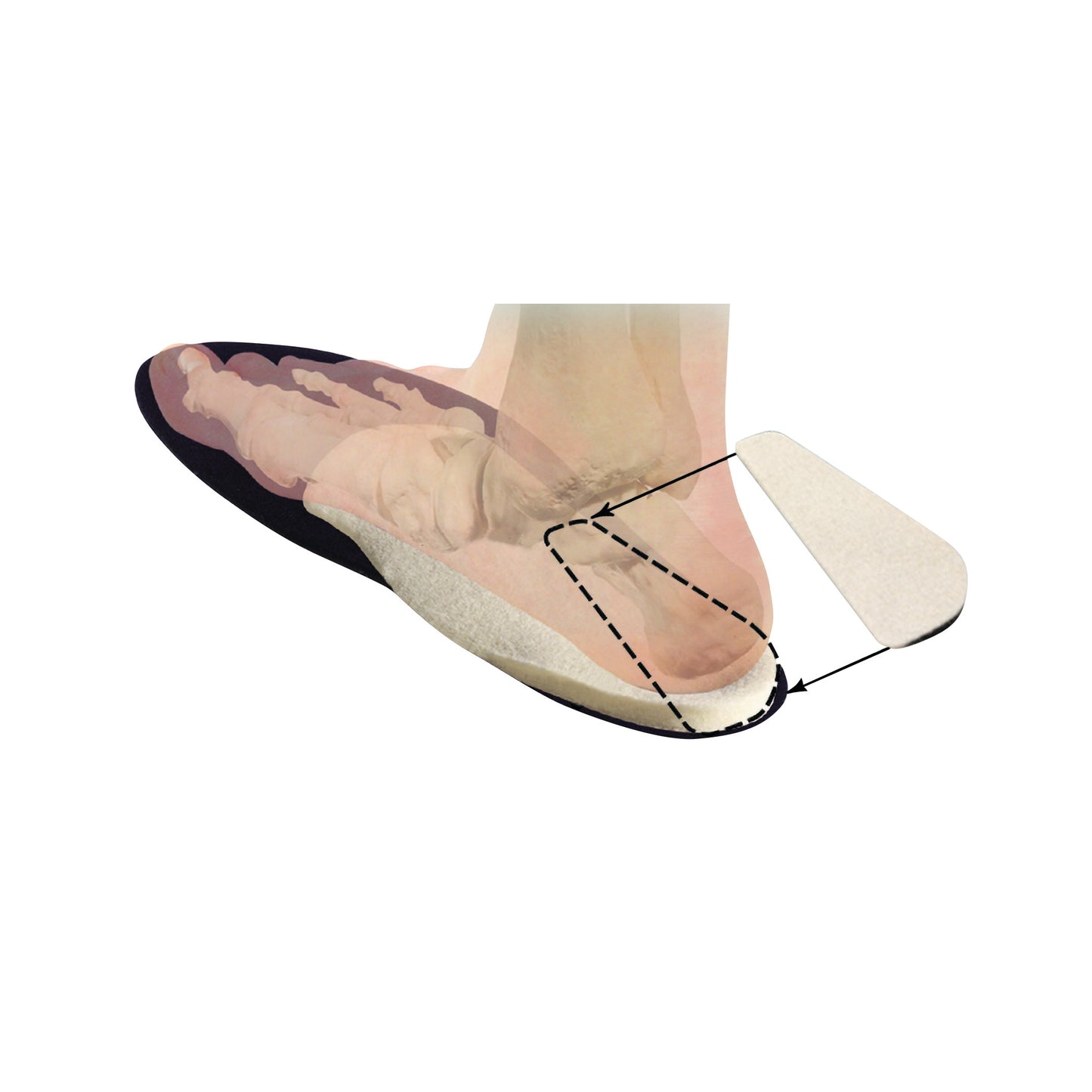 A cutaway illustration of a foot inside a shoe using the Hapad Posting Heel Wedge to show foot alignment and support.