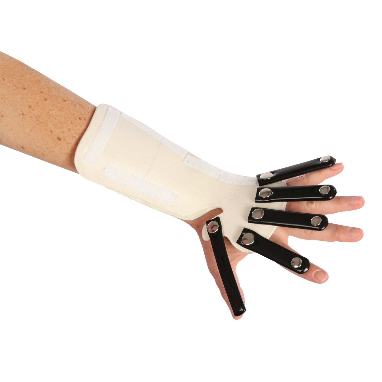 The AliMed Forearm-Based Radial Nerve Splint supports a hand with black metal finger extensions, aiding movement and alignment.