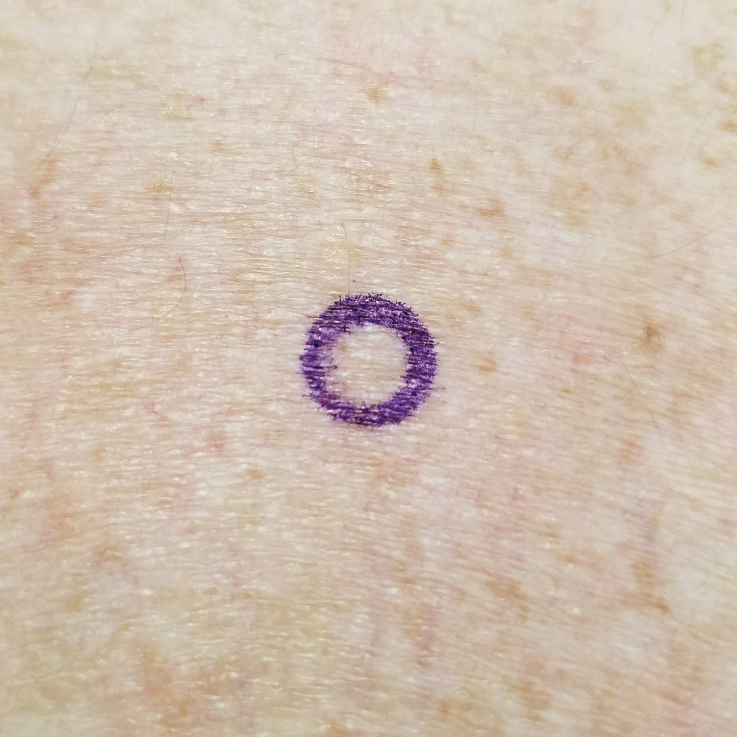 Close-up of skin with a purple circle drawn on it, using Viscot Accumark Radiopaque Injection Site Markers.